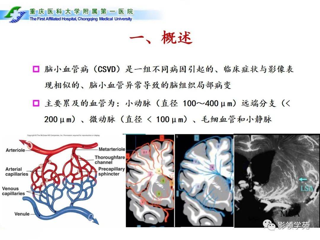 脑小血管病的影像学诊断