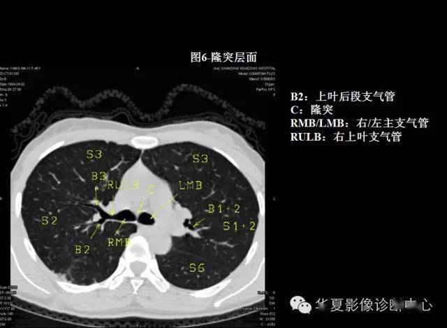 本文来源:华夏影像诊断中心 掌握肺部疾病ct,快速学好肺部感染ct,so