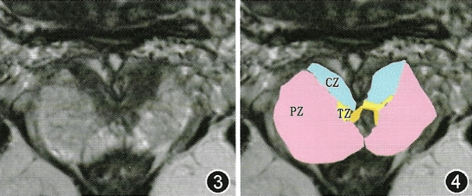 前列腺丨mri解剖分区