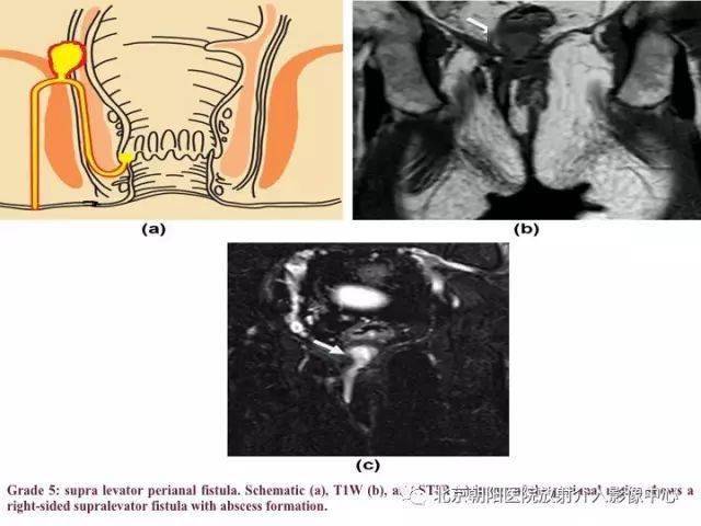 图解肛瘘的解剖和影像诊断