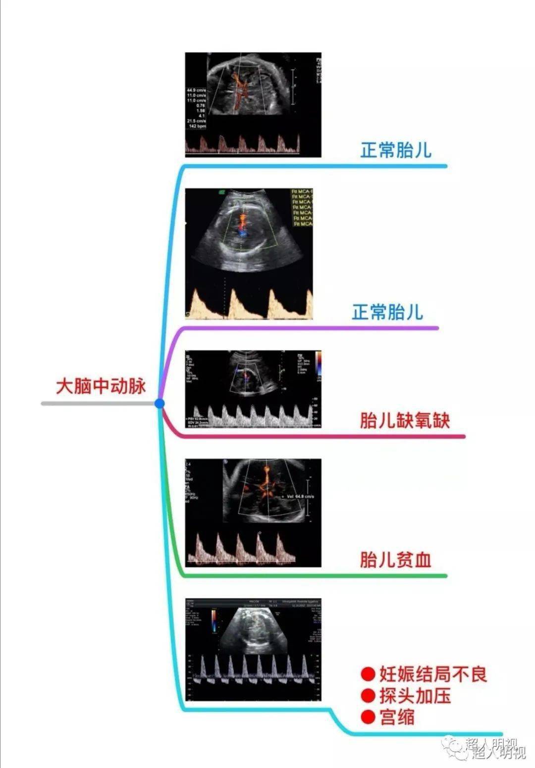 胎儿大脑中动脉