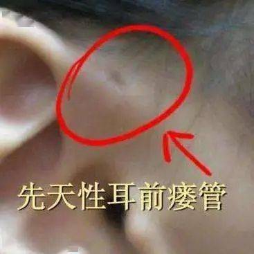 专家谈——什么是耳前瘘管?耳前瘘管反复感染,有必要切除吗?
