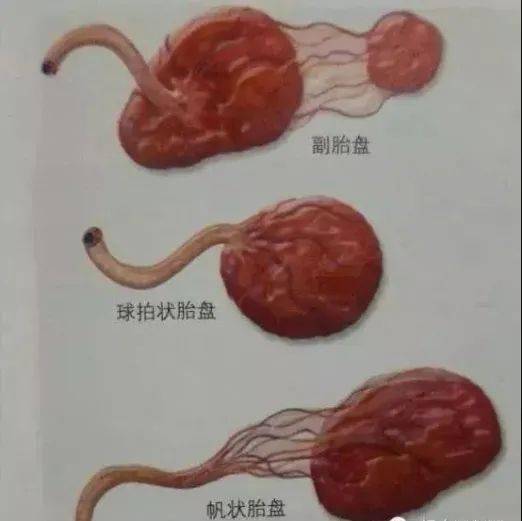 脐带是附着于胎盘上的,而帆状胎盘,脐带是附着于胎盘之外的胎膜上