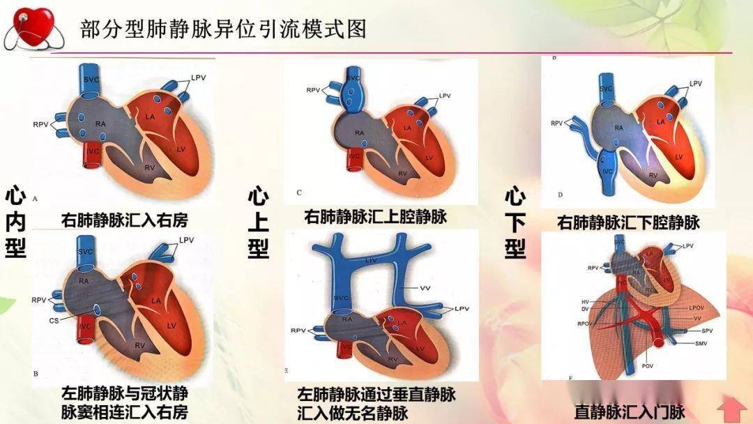 部分性肺静脉异位引流的病例分析