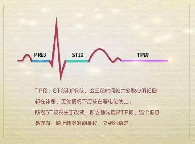 简单4个步骤,读懂st-t段改变特点!