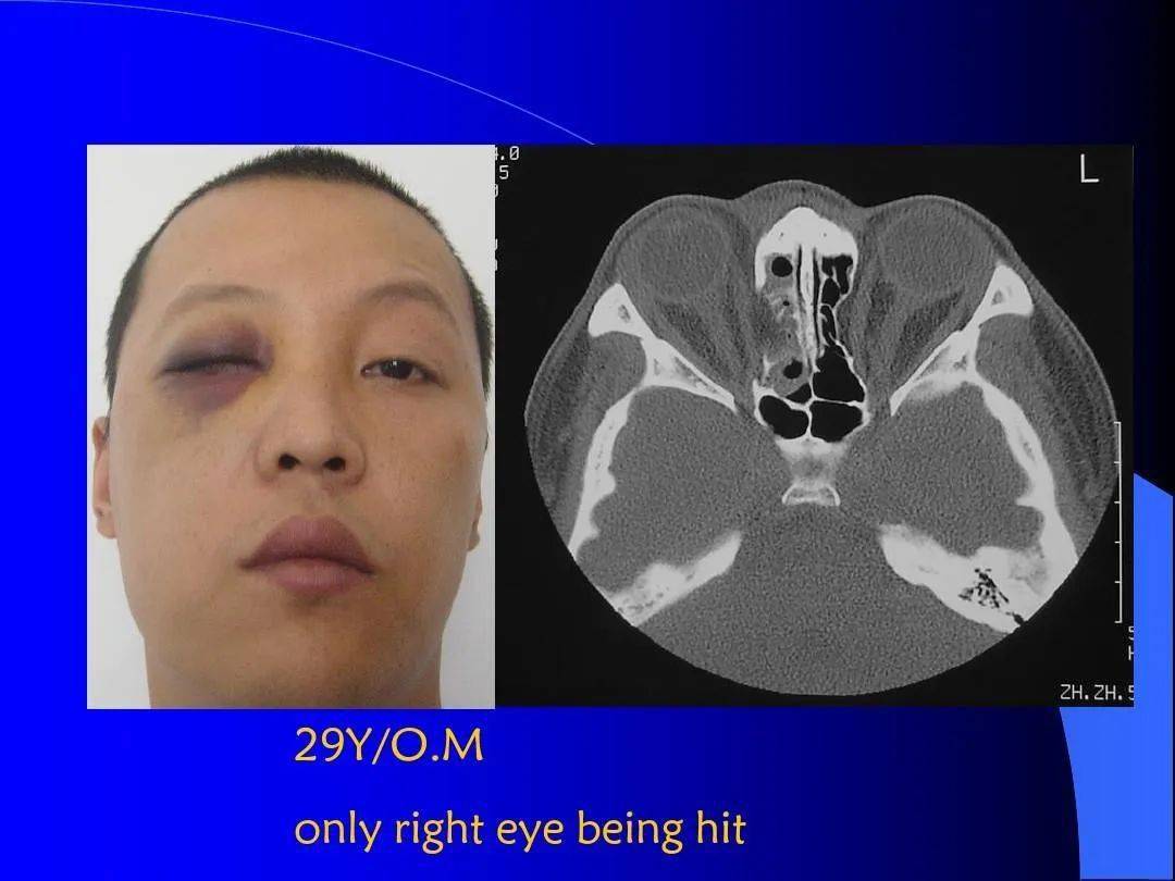 眼眶骨折常见的ct表现