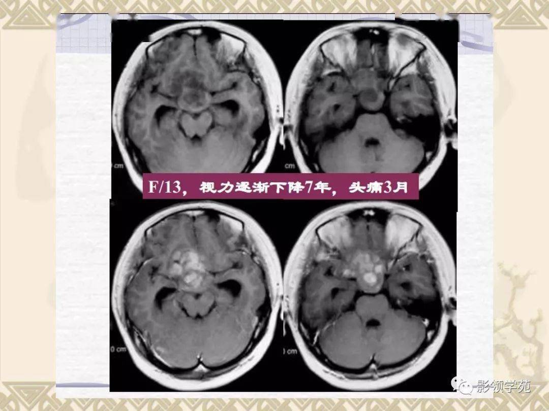 垂体病变的mri诊断