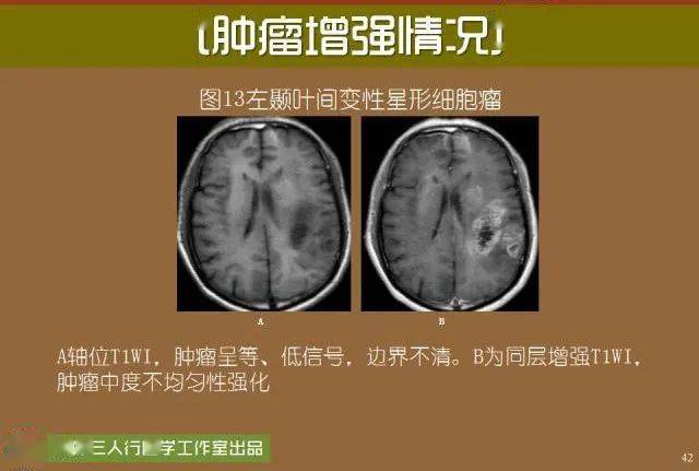 颅内高潮什么原理_颅内动脉瘤图片(3)