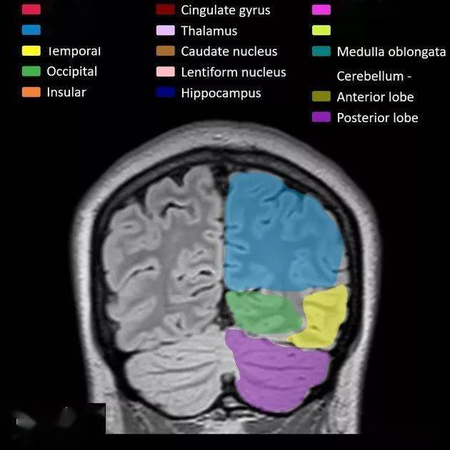 mr入门丨脑叶解剖分布mri图像彩色标注