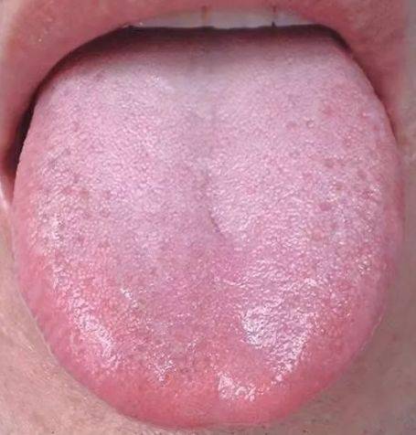 舌头中间有裂纹或者边缘有齿痕等是疾病征兆现在知道还不晚