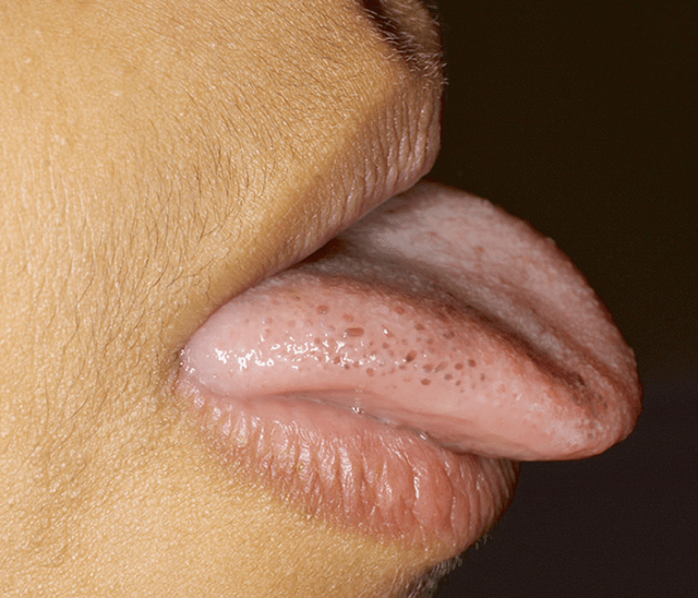今日病例:舌头长黑点是为何?