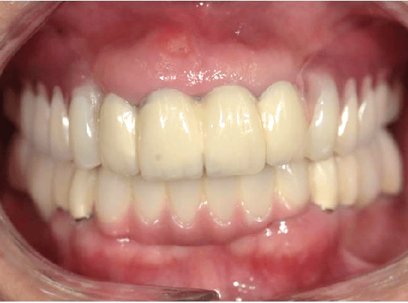 记录60岁老人看牙经历:满口松牙烂牙,一颗没拔全保住了