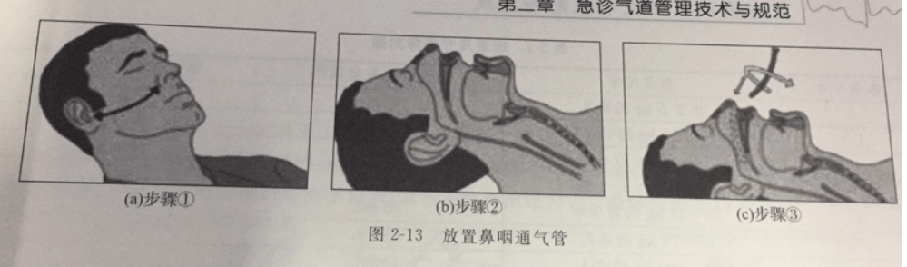 鼻咽通气管插至足够深度后,如果病人咳嗽或拒抗,应将欺其后退1～2cm.
