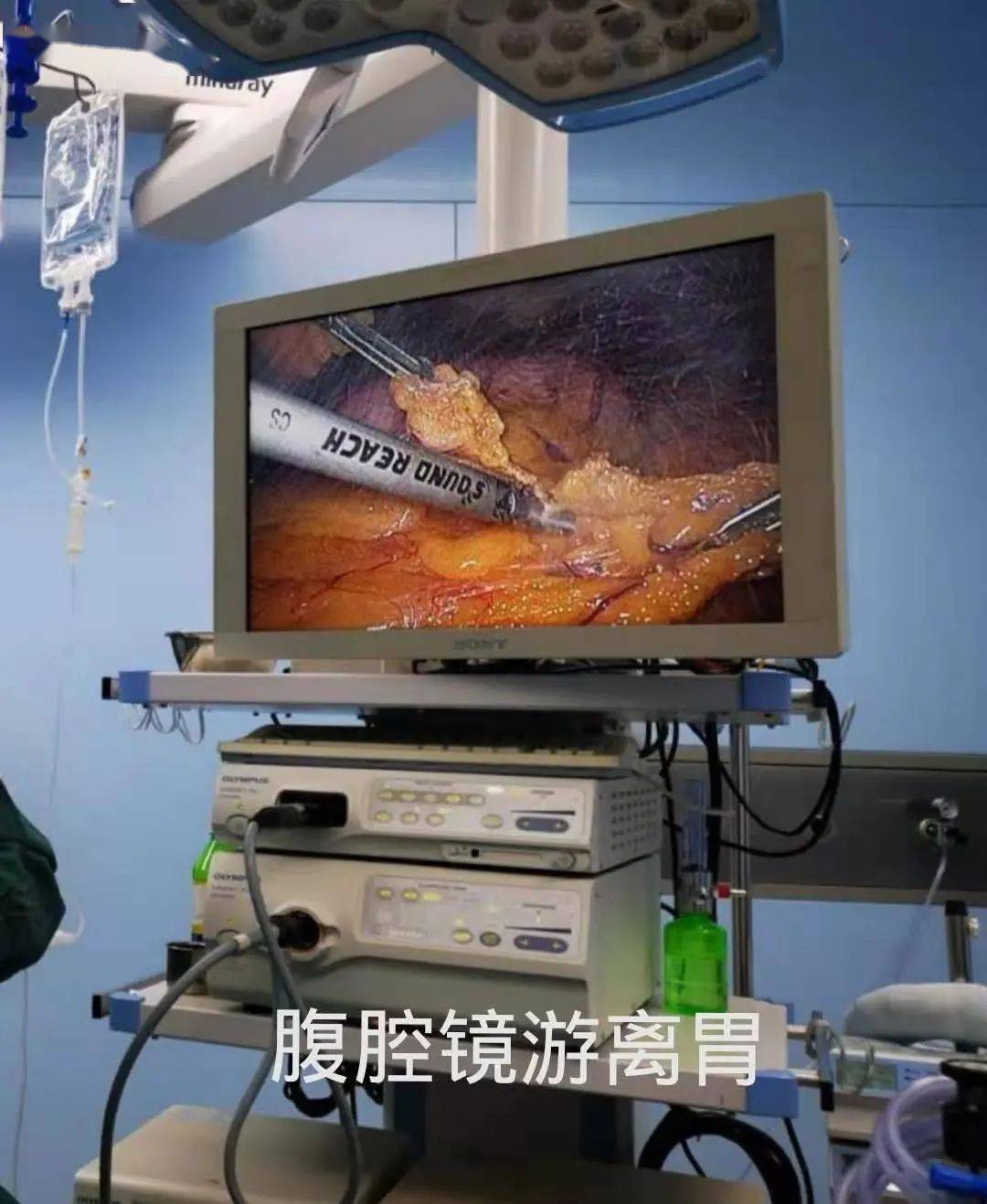 胸腔镜联合腹腔镜 食管癌手术不再是"过鬼门关"