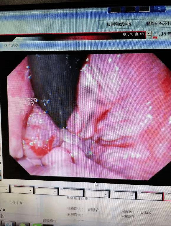 女性患者引起了他的注意,患者肛门松驰,内痔i期,检查前不适症状有肛门