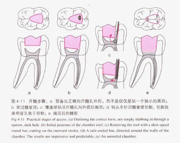 标准开髓口形态_上颌