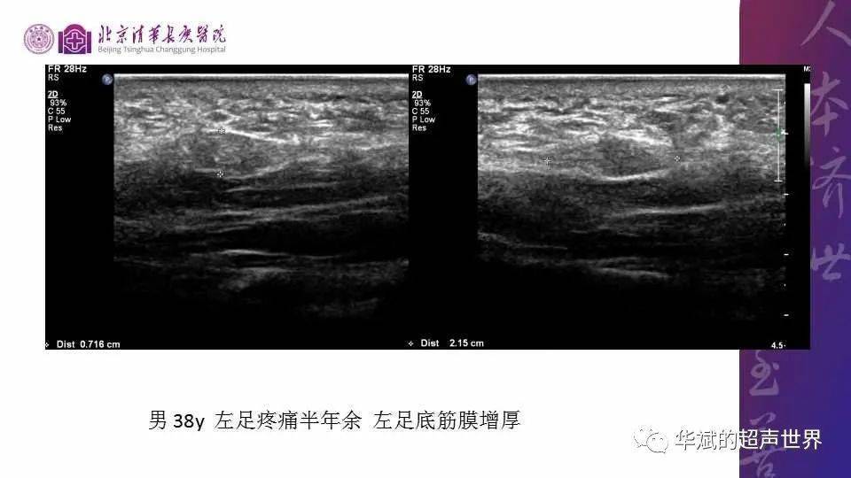 病例和文献复习:结节性筋膜炎_手机搜狐网