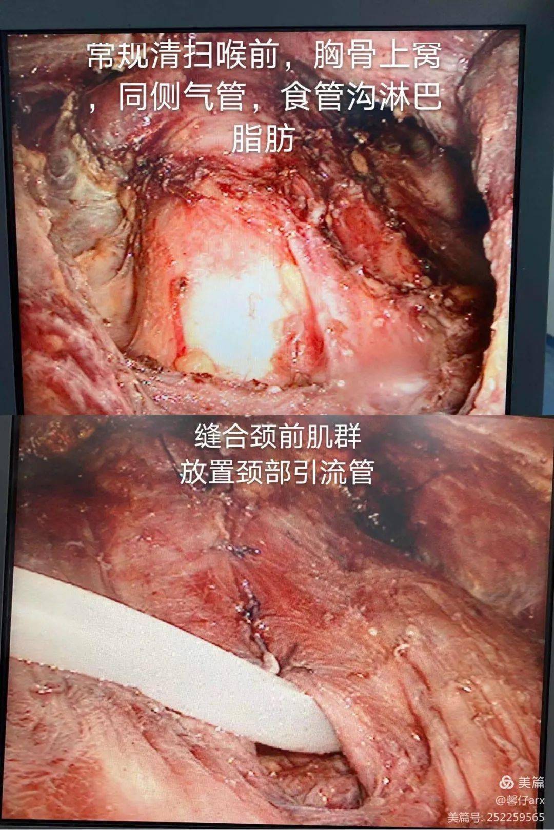 甲状腺淋巴结分区