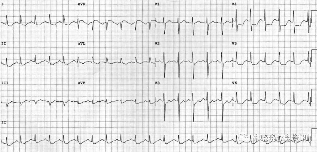 心肌缺血的心电图表现