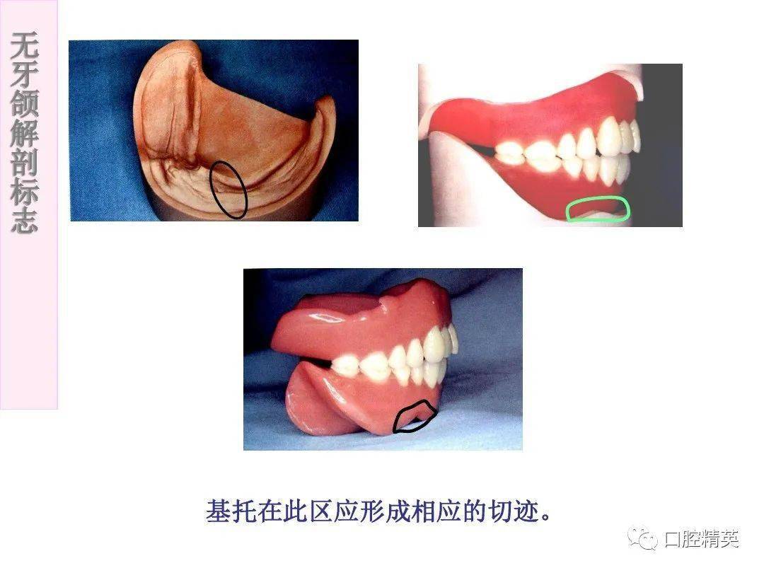 无牙颌解剖标志