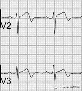 心肌缺血的心电图表现