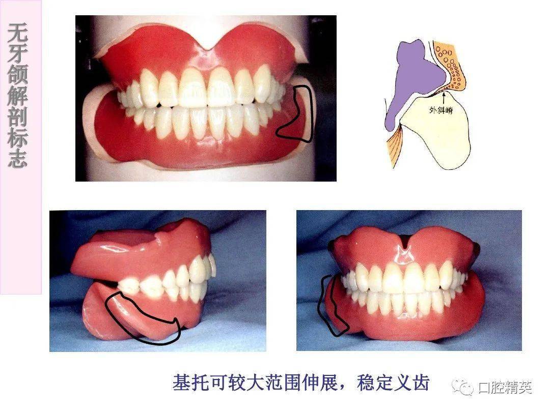 无牙颌解剖标志