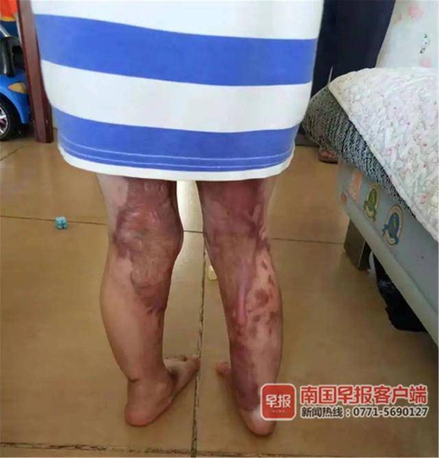 洗屁股前幼师没测水温,防城港一男童被烫成九级伤残