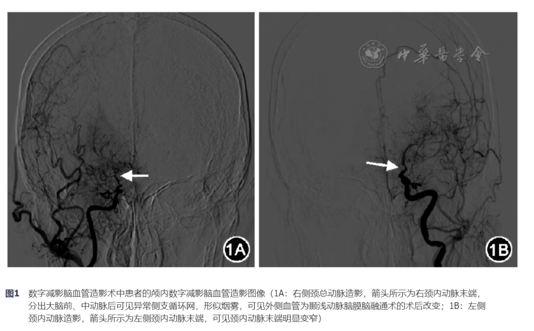 【病例报告】经皮左心耳封堵术治疗持续心房颤动合并烟雾病一例