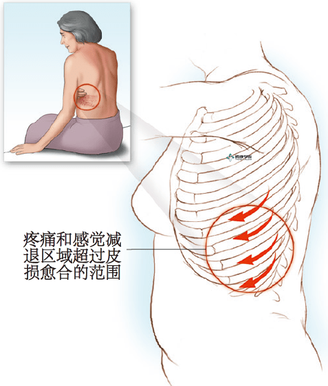 内脏痛由外周c纤维介导,由脊髓向中枢传递主要终止于边缘系统.