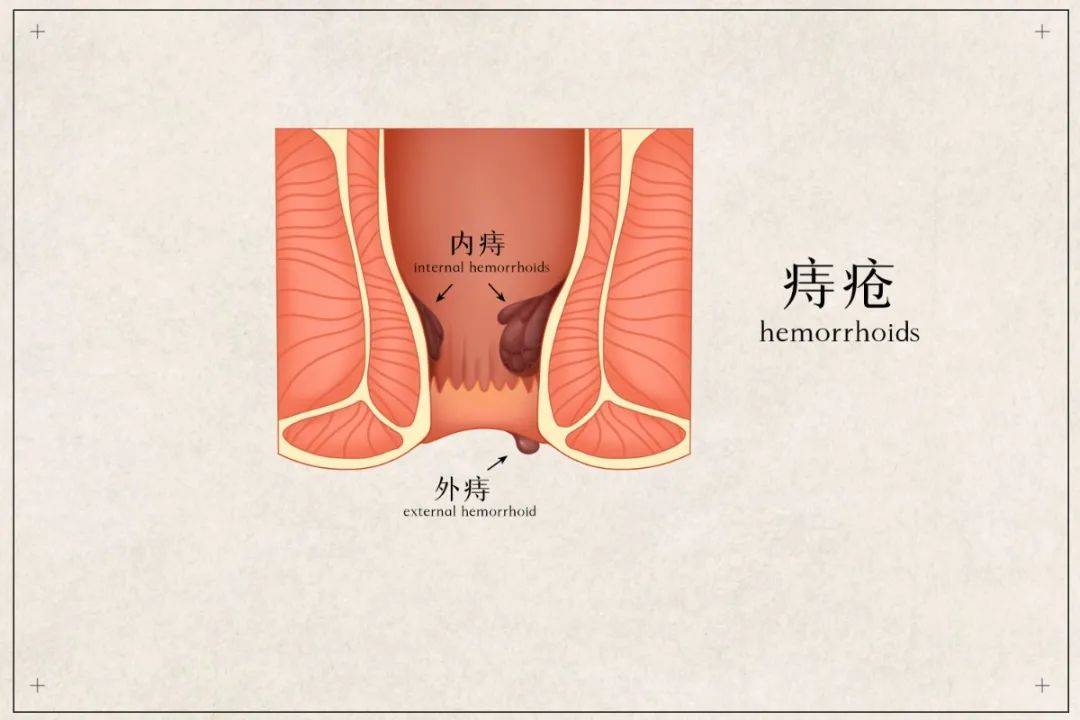 直肠黏膜(齿状线)为分界,在 齿状线以内的称为内痔,以外的则称为外痔