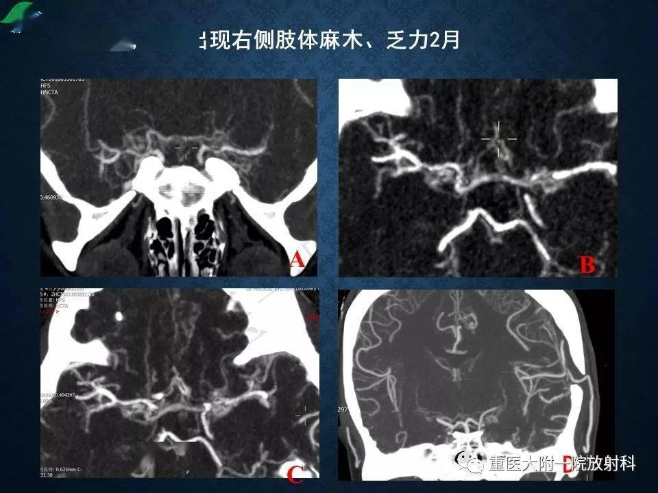 烟雾病的影像学诊断