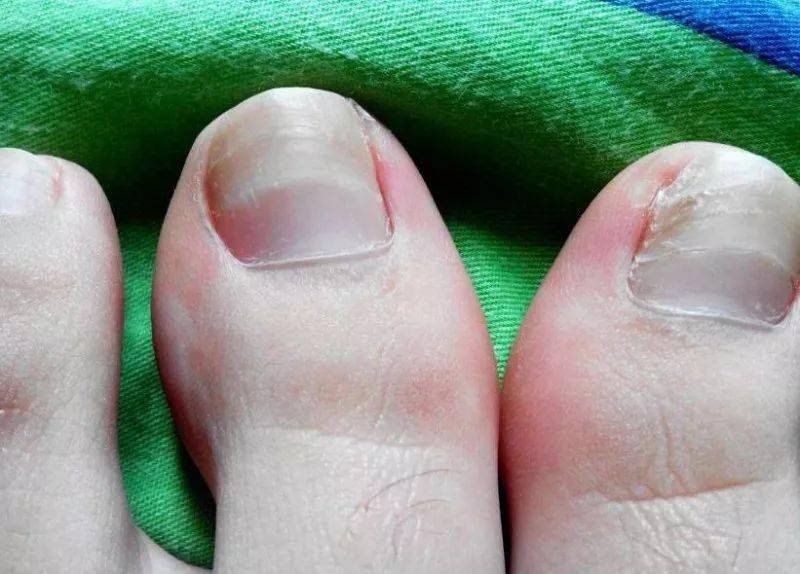 治疗灰指甲该如何用药?