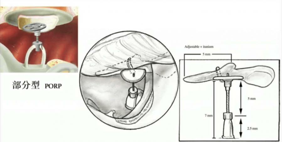 人工听小骨植入手术示意图