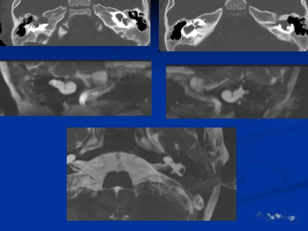 内耳畸形影像学表现