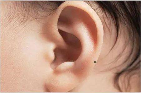 耳后有痣代表什么?_耳朵