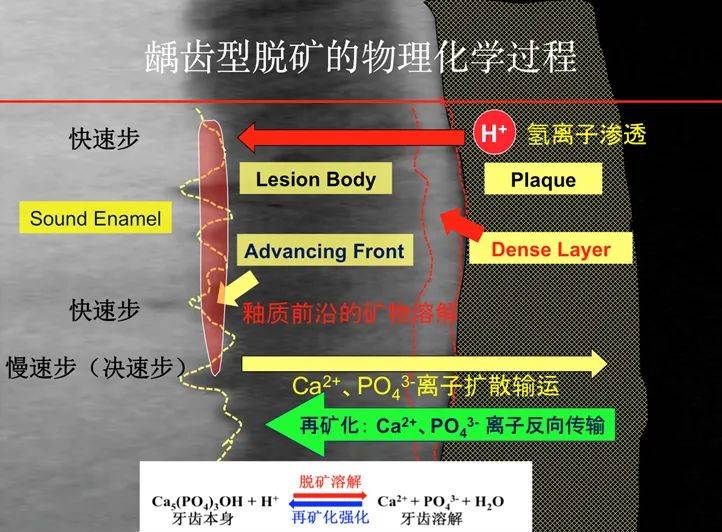 牙齿脱矿和再矿化的基本原理