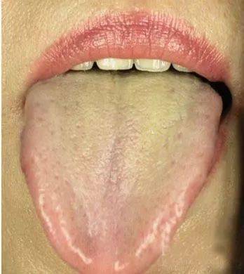 5类舌苔症状,对症用药方案来了