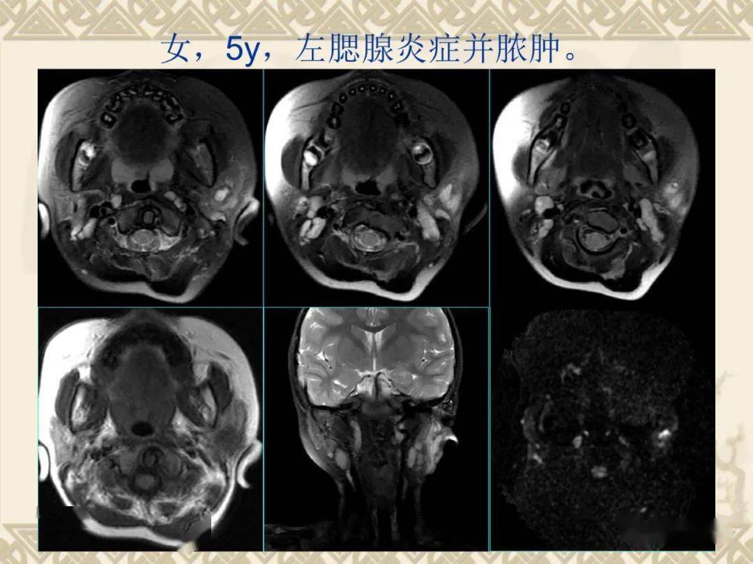 腮腺解剖及病变影像学表现