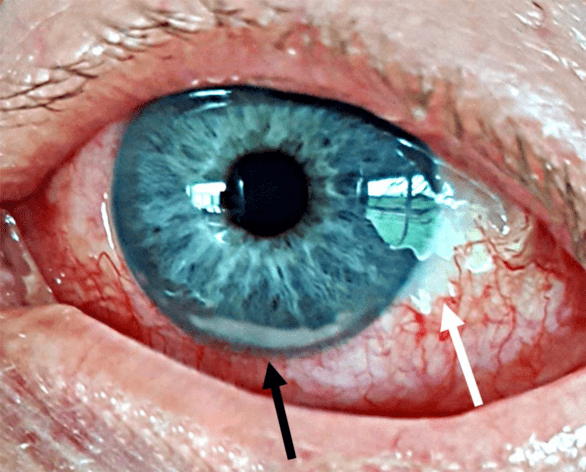左眼边缘性角膜炎;2.左眼眼表鳞状细胞瘤切除术后;3.溃疡性结肠炎.