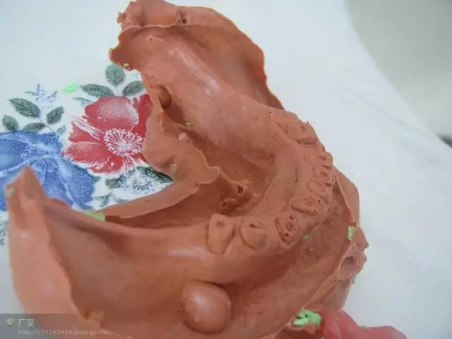 活动义齿可以不每天摘下吗 5bb5c06f57d74dedbf9e9c92d91f3c63.jpeg