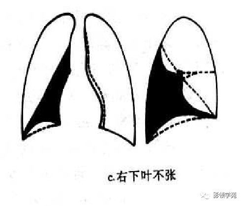 肺门为尖片状密度增高影,斜裂呈凸面向上弧形,左肺门向上移位或与肺不