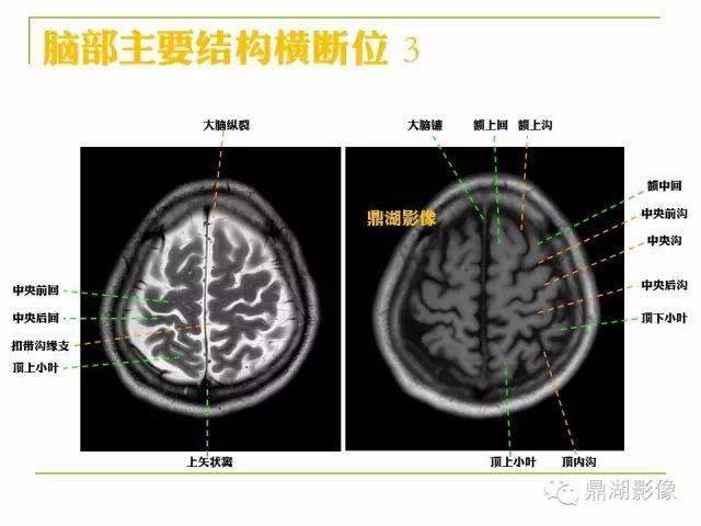 高清头颅mr解剖图谱_断层