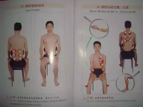 拔下火罐,病好一半! (图解拔火罐穴位)