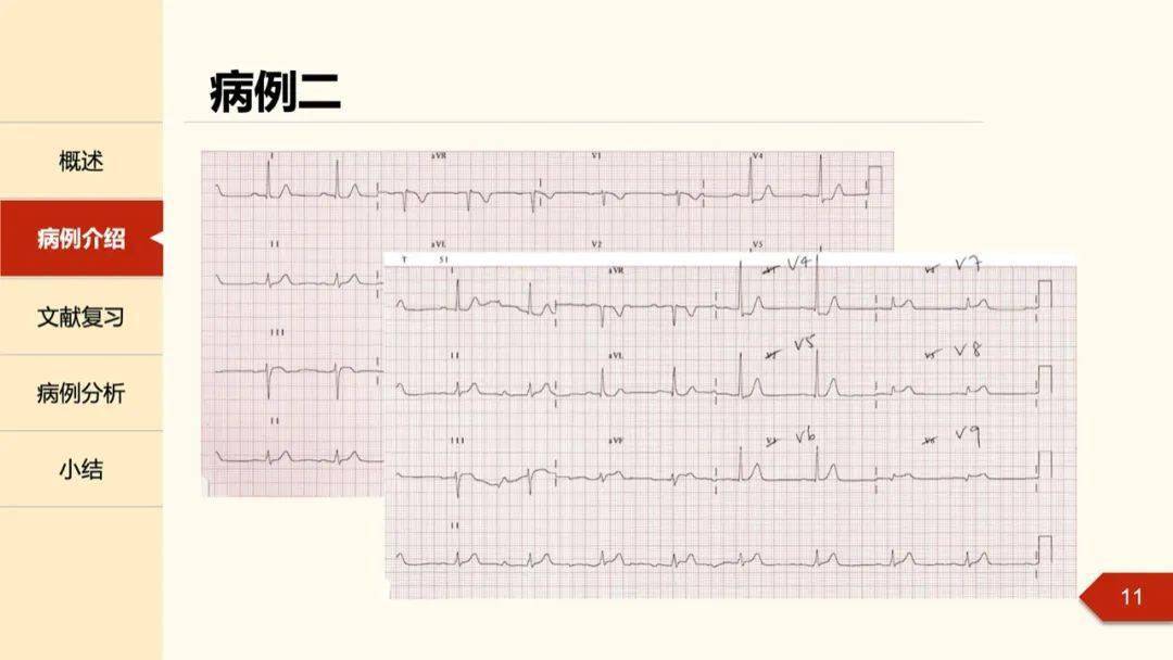 急性正后壁心肌梗死是由于左回旋支闭塞,右冠状动脉左室后侧支,引起