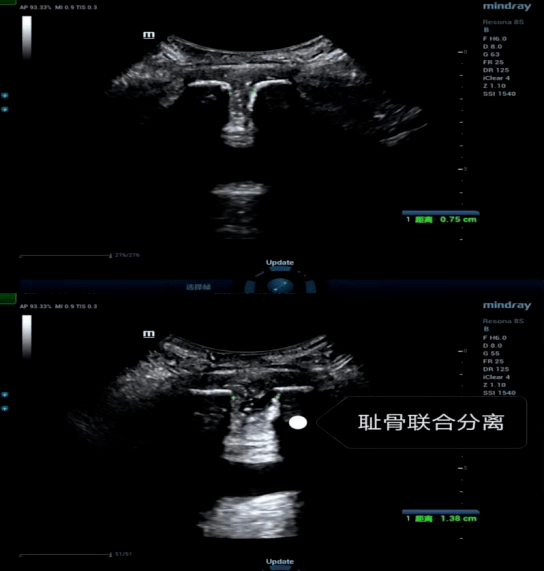 妇幼健康丨超声探头下的耻骨联合分离——孕产期难言之痛!