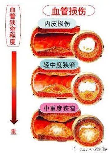 "颈动脉斑块"导致血管狭窄,怎么办?