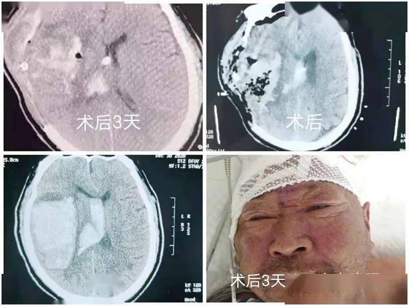 太赞了 郸城首例三脑室微创穿刺成功救治脑出血患者