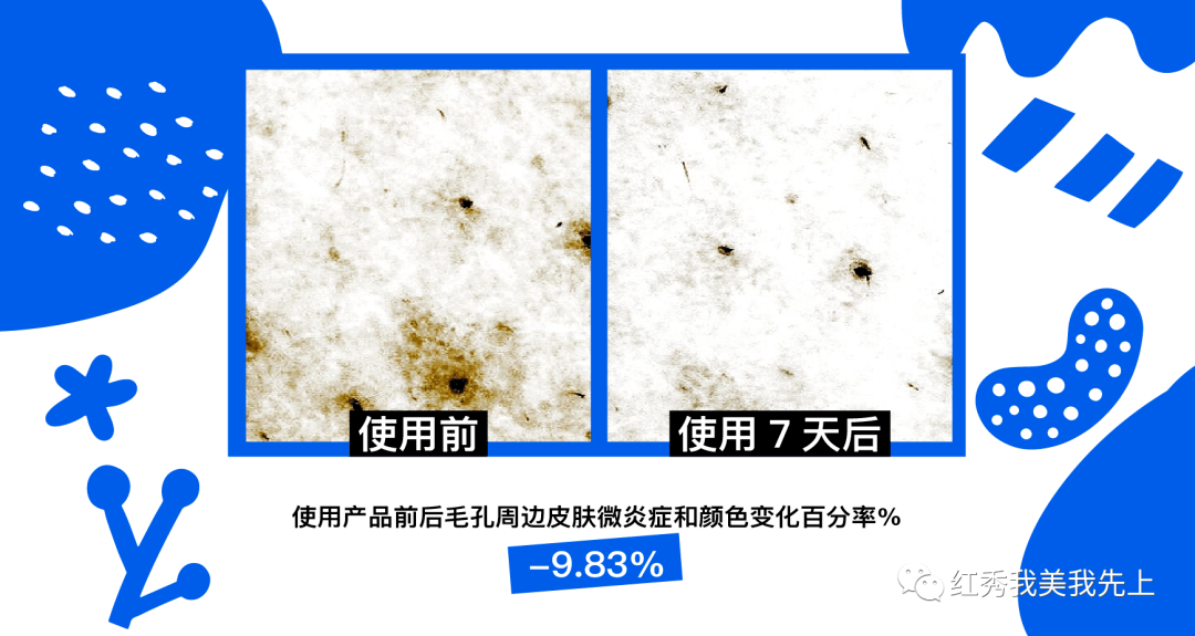 色素沉淀什么时候能消 dce82646275e41b3a23b660ee09aae0e.png