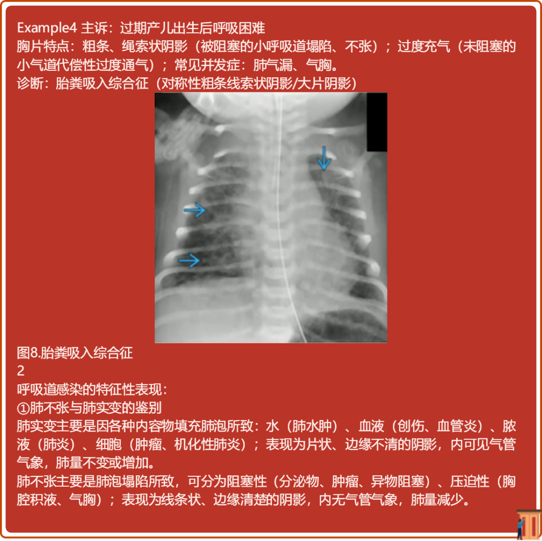 读完此文,终于会看儿童胸片了