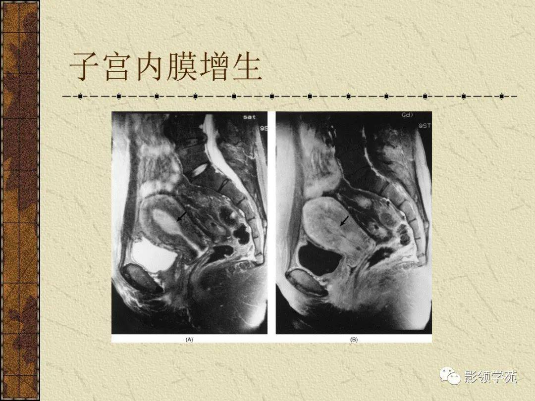 女性盆腔病变的mri诊断